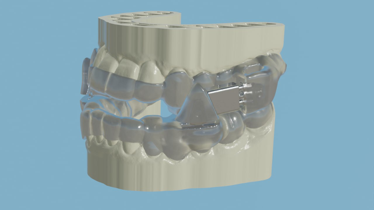 Customized Anti-Snoring Solution Bite